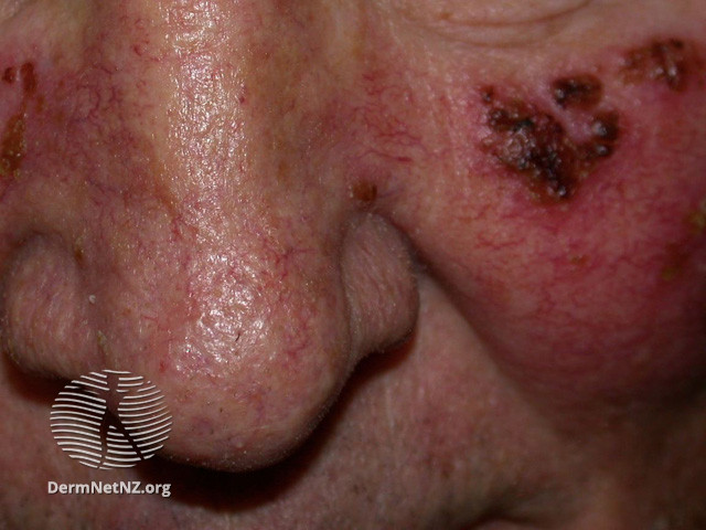 File:Actinic Keratoses treated with imiquimod (DermNet NZ lesions-ak-imiquimod-3734).jpg