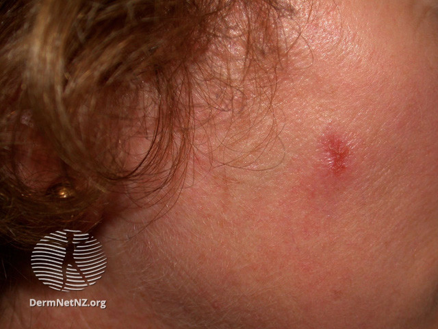 Actinic Keratoses treated with imiquimod (DermNet NZ lesions-ak-imiquimod-3736).jpg