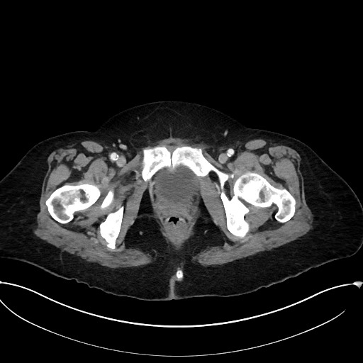 File:Active Crohn disease (Radiopaedia 59394-66750 Axial C+ portal venous phase 71).jpg
