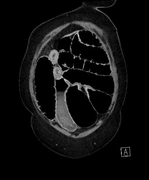 Active Crohn disease (Radiopaedia 59394-66750 Coronal C+ portal venous phase 15).jpg