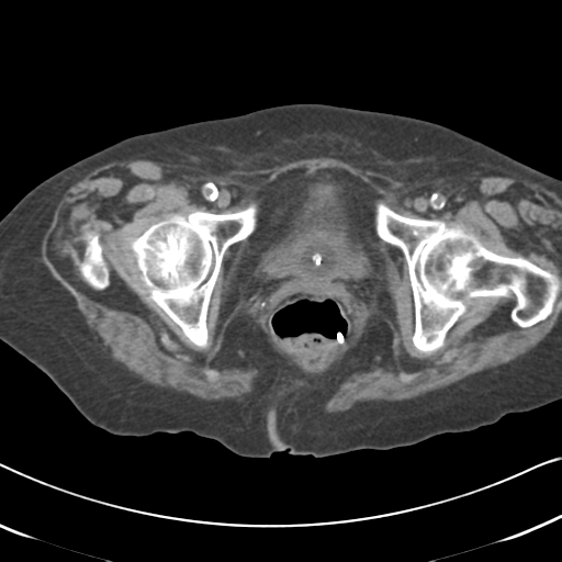 File:Active bleeding from duodenal ulcer with embolization (Radiopaedia 34216-35481 Axial non-contrast 66).png