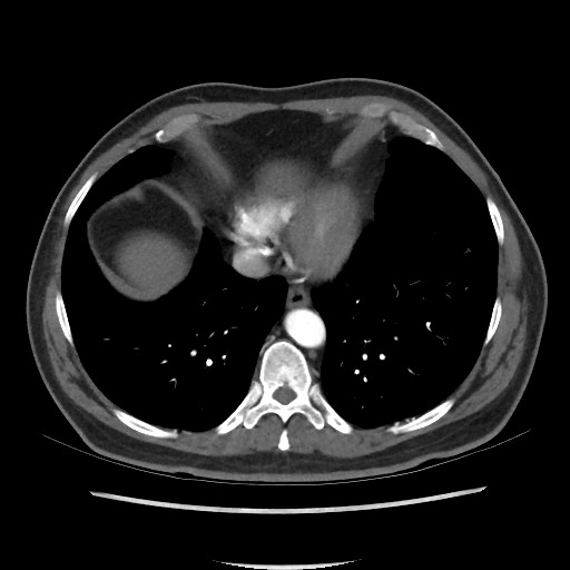 Active colonic bleed on CT (Radiopaedia 49765-55025 Axial C+ arterial phase 7).jpg