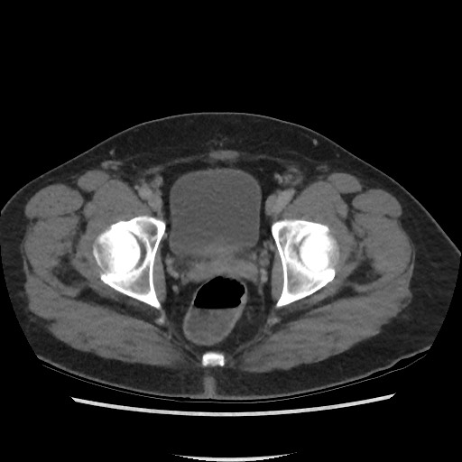File:Active colonic bleed on CT (Radiopaedia 49765-55025 Axial C+ delayed 77).jpg
