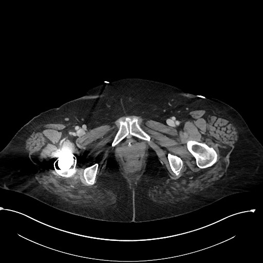 File:Active renal extravasation with large subcapsular and retroperitoneal hemorrhage (Radiopaedia 60975-68796 Axial 342).jpg