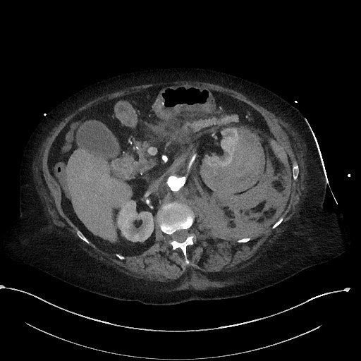 File:Active renal extravasation with large subcapsular and retroperitoneal hemorrhage (Radiopaedia 60975-68796 Axial C+ arterial phase 74).jpg