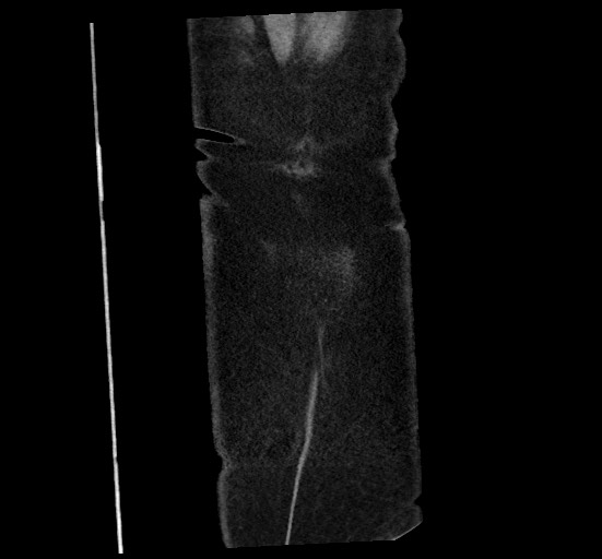 File:Active renal extravasation with large subcapsular and retroperitoneal hemorrhage (Radiopaedia 60975-68796 Coronal C+ portal venous phase 148).jpg