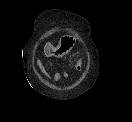 File:Active renal extravasation with large subcapsular and retroperitoneal hemorrhage (Radiopaedia 60975-68796 Coronal C+ portal venous phase 26).jpg
