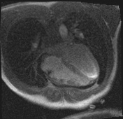 Active right ventricular cardiac sarcoidosis (Radiopaedia 55596-62100 Axial Dynamic perfusion scan MOCO 83).jpg