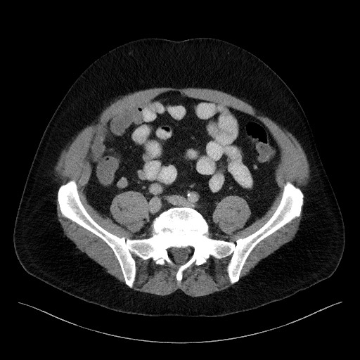 Acute-on-chronic pancreatitis (Radiopaedia 67286-76656 Axial C+ portal venous phase 56).jpg