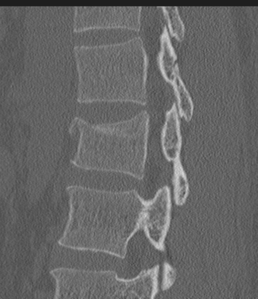 Acute L1 burst compression fracture (Radiopaedia 34430-35755 Sagittal bone window 26).png