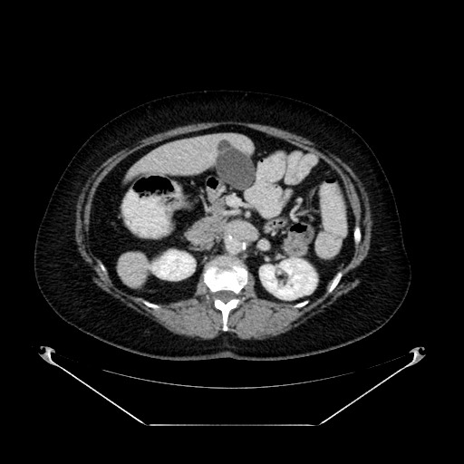 Acute appendicitis, heterotaxy syndrome (Radiopaedia 66884-76202 Axial C+ portal venous phase 47).jpg