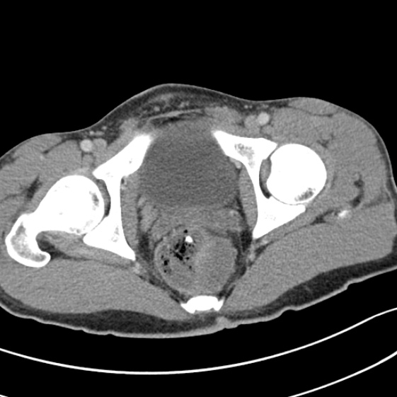 Acute appendicitis (Radiopaedia 32614-33572 Axial C+ portal venous phase 65).jpg