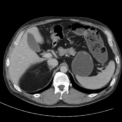 File:Acute appendicitis (Radiopaedia 66513-75790 Axial C+ portal venous phase 11).jpg