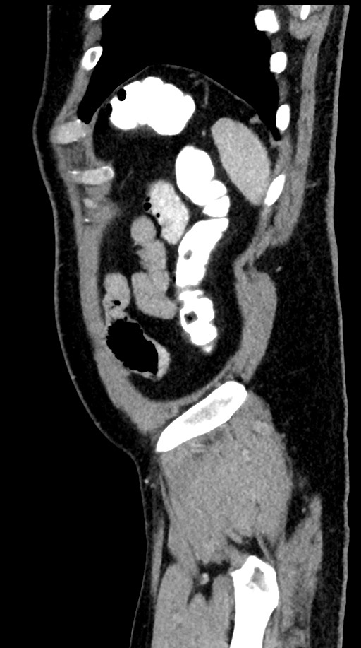 Acute appendicitis (Radiopaedia 77016-88960 Sagittal C+ portal venous phase 15).jpg