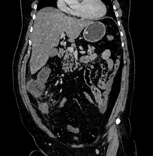 Acute appendicitis (Radiopaedia 79950-93224 Coronal C+ portal venous phase 35).jpg