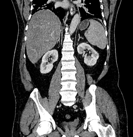 Acute appendicitis (Radiopaedia 79950-93224 Coronal C+ portal venous phase 61).jpg