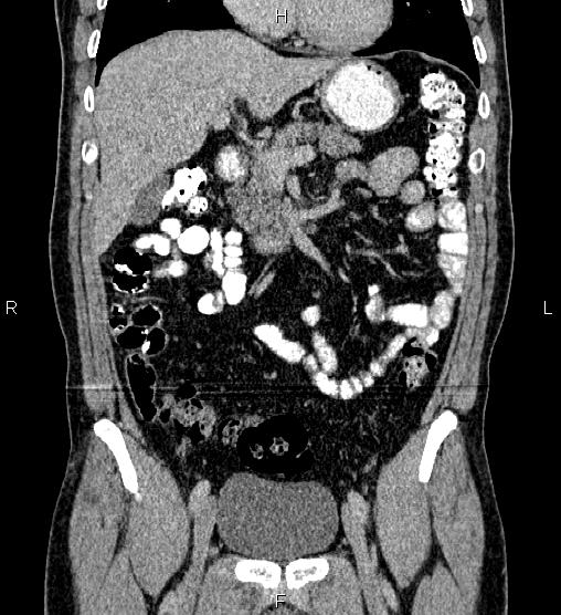 Acute appendicitis (Radiopaedia 84780-100240 Coronal C+ portal venous phase 31).jpg