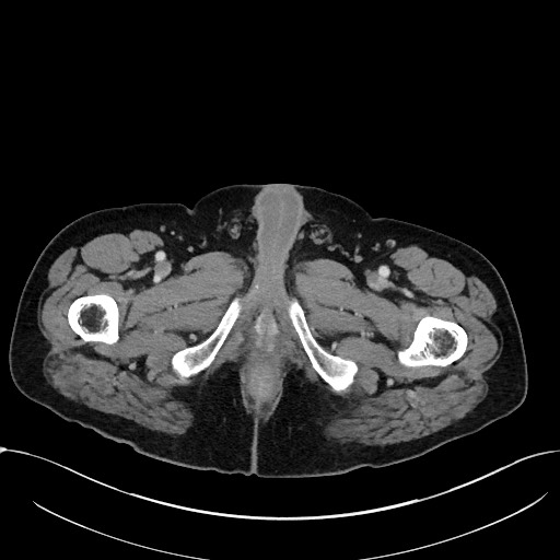 File:Acute appendicitis - large appendicoliths (Radiopaedia 61805-69820 Axial C+ portal venous phase 146).jpg