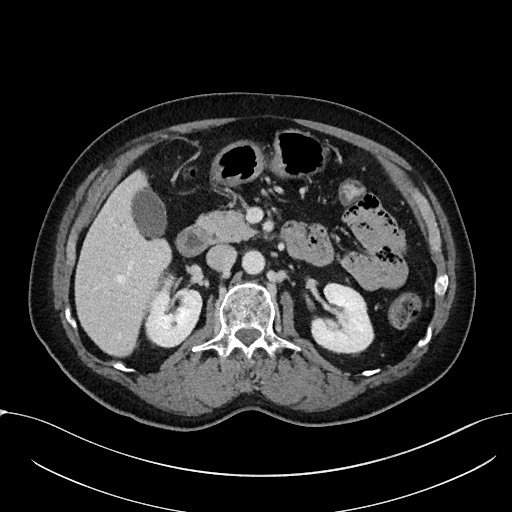 Acute appendicitis - large appendicoliths (Radiopaedia 61805-69820 Axial C+ portal venous phase 47).jpg