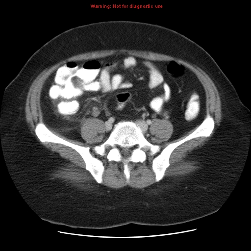 Acute appendicitis complicated by ovarian vein thrombophlebitis (Radiopaedia 16172-15851 Axial C+ portal venous phase 64).jpg