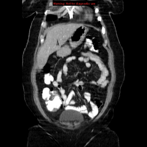 File:Acute appendicitis complicated by ovarian vein thrombophlebitis (Radiopaedia 16172-15851 Coronal C+ portal venous phase 23).jpg