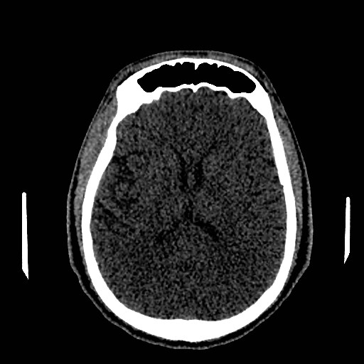 Acute basilar artery occlusion (Radiopaedia 43582-46985 Axial non-contrast 104).jpg