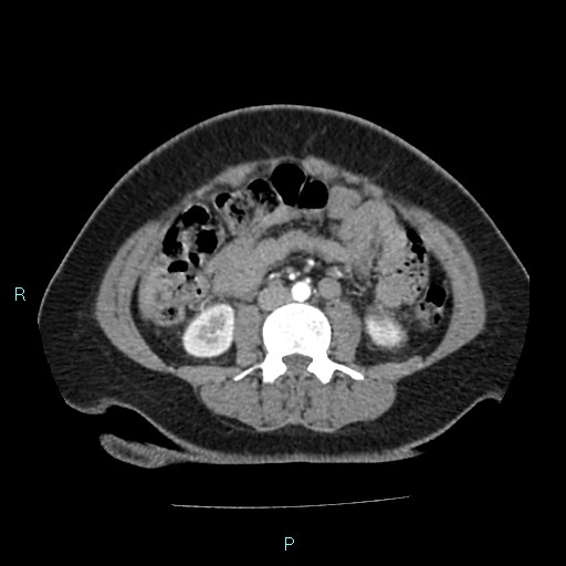 Acute bilateral pyelonephritis (Radiopaedia 37146-38881 Axial C+ arterial phase 105).jpg
