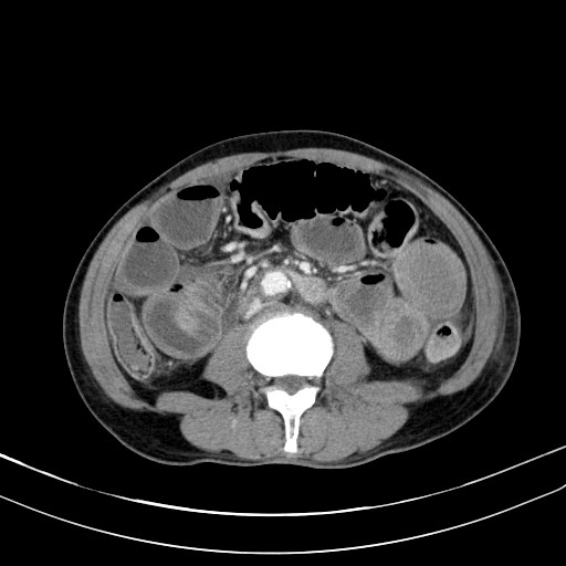 Acute bowel ischemia (Radiopaedia 87695-104114 Axial C+ portal venous phase 45).jpg