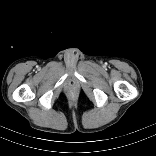 Acute bowel ischemia (Radiopaedia 87695-104114 Axial C+ portal venous phase 90).jpg