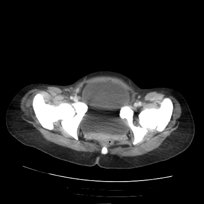 Acute calculous cholecystitis in patient with osteopetrosis (Radiopaedia 77871-90159 Axial C+ portal venous phase 76).jpg