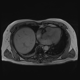 Acute cholecystitis (Radiopaedia 72392-82923 Axial T1 out-of-phase 16).jpg