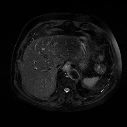 File:Acute cholecystitis complicated by pylephlebitis (Radiopaedia 65782-74915 Axial T2 fat sat 10).jpg
