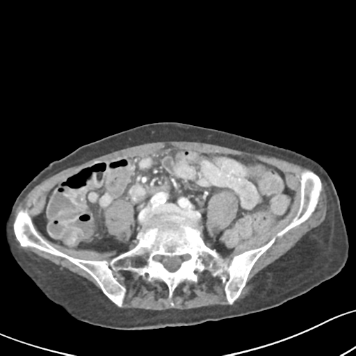 File:Acute cholecystitis with contained perforation (Radiopaedia 47328-51907 Axial C+ portal venous phase 47).png