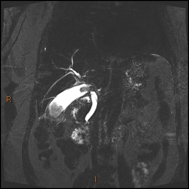 File:Acute cholecystitis with gallbladder neck calculus (Radiopaedia 42795-45971 Coronal Turbo spin echo 19).jpg