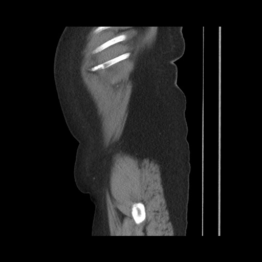 Acute cholecystitis with tensile fundus sign (Radiopaedia 71394-81723 Sagittal non-contrast 34).jpg