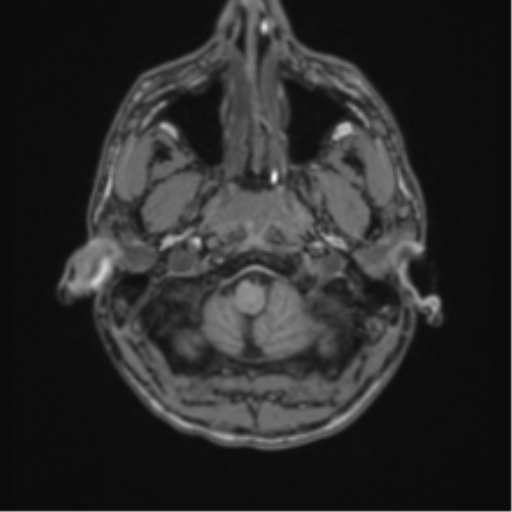 Acute disseminated encephalomyelitis (ADEM) (Radiopaedia 65319-74349 Axial T1 2).png