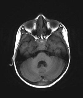 File:Acute disseminating encephalomyelitis with bilateral optic neuritis (Radiopaedia 79676-92886 Axial T1 7).jpg