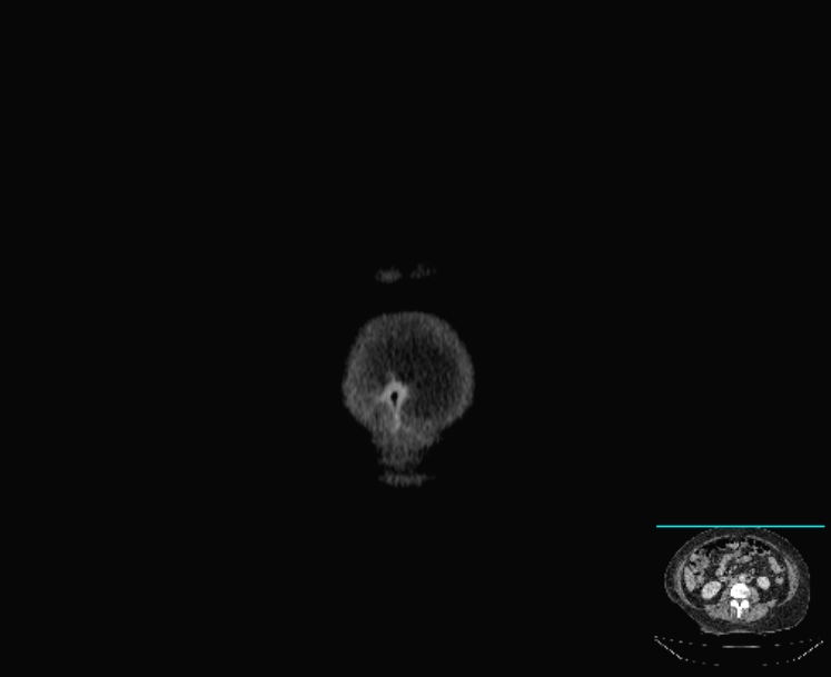Acute diverticulitis (Radiopaedia 28066-28325 Coronal C+ portal venous phase 2).jpg