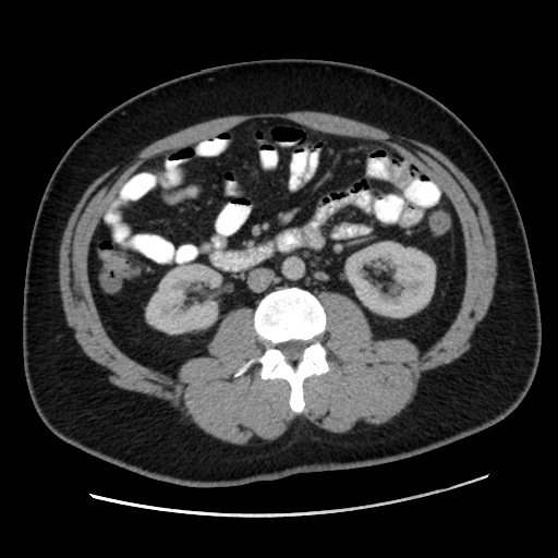 File:Acute diverticulitis with localized perforation (Radiopaedia 41296-44113 Axial C+ portal venous phase 44).jpg