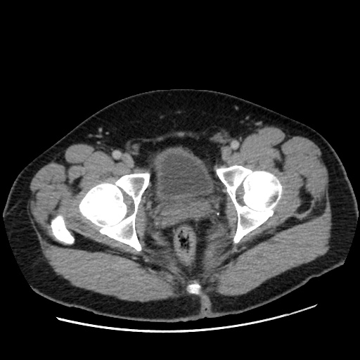 File:Acute diverticulitis with localized perforation (Radiopaedia 41296-44113 Axial C+ portal venous phase 87).jpg