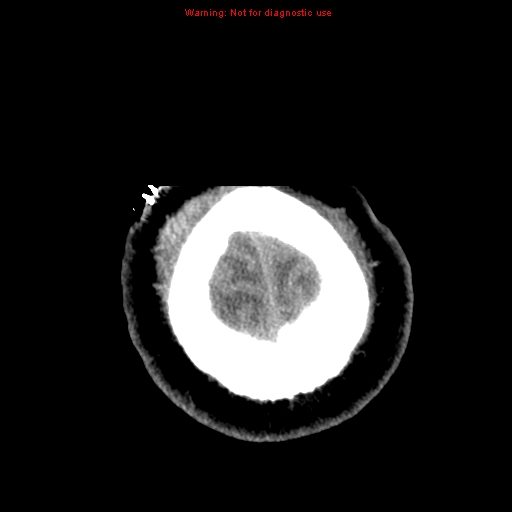 File:Acute hemorrhagic leukoencephalitis (Radiopaedia 14076-72275 Axial non-contrast 45).jpg