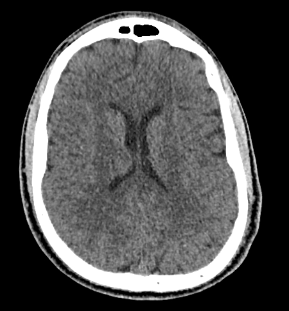Acute ischemic stroke - posterior circulation territory (Radiopaedia 77670-89881 non-contrast 55).jpg