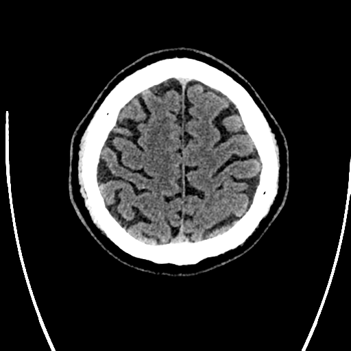 File:Acute left middle cerebral artery territory ischemic stroke (Radiopaedia 35688-37223 Axial non-contrast 71).png