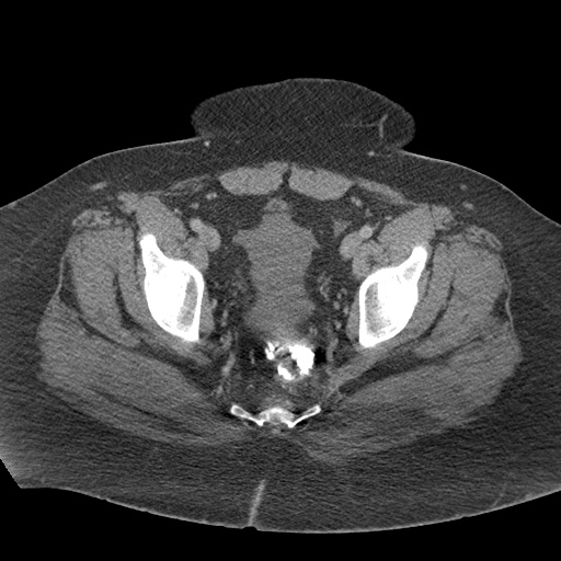 Acute mesenteric venous ischemia (Radiopaedia 46041-50383 Axial C+ portal venous phase 128).jpg