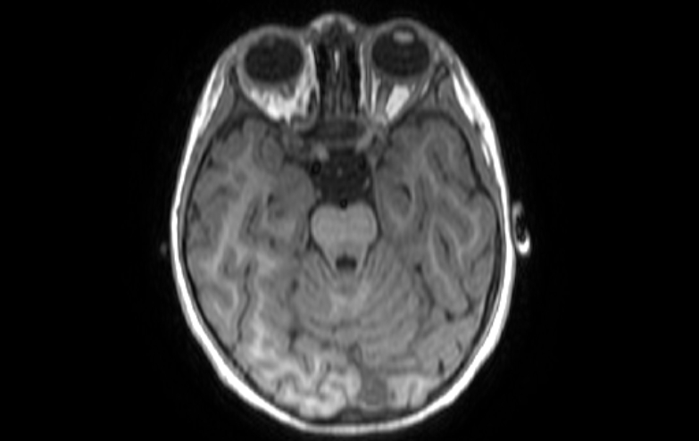 Acute necrotizing encephalitis of childhood (Radiopaedia 67356-76737 Axial T1 65).jpg