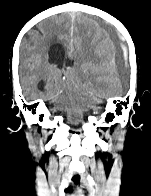 Acute on chronic subdural hematoma (Radiopaedia 74814-85823 Coronal non-contrast 40).jpg