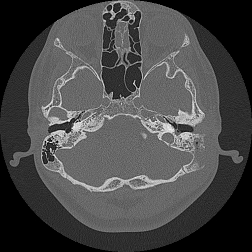 Acute otomastoiditis and Bezold abscess (Radiopaedia 88184-104786 Axial bone window 29).jpg