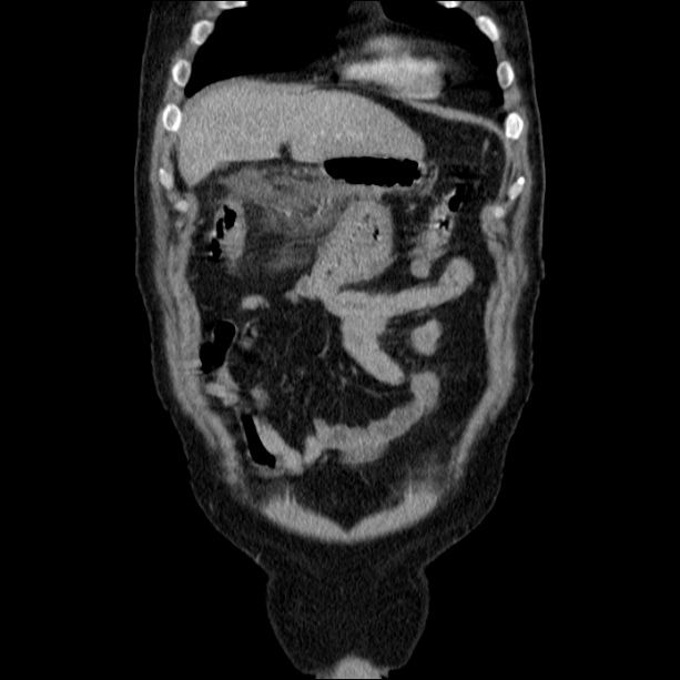Acute pancreatitis (Radiopaedia 26663-26813 Coronal C+ portal venous phase 15).jpg