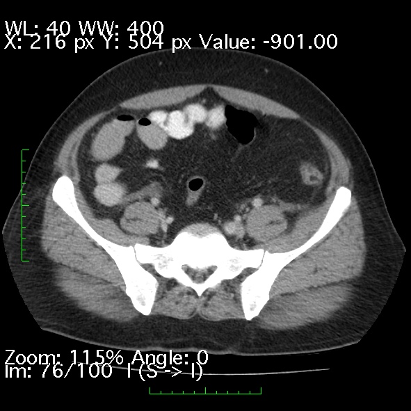 Acute pancreatitis (Radiopaedia 34043-35276 Axial C+ portal venous phase 76).jpg