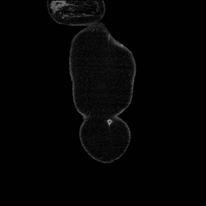 Acute pancreatitis (Radiopaedia 69236-79012 Coronal C+ portal venous phase 71).jpg